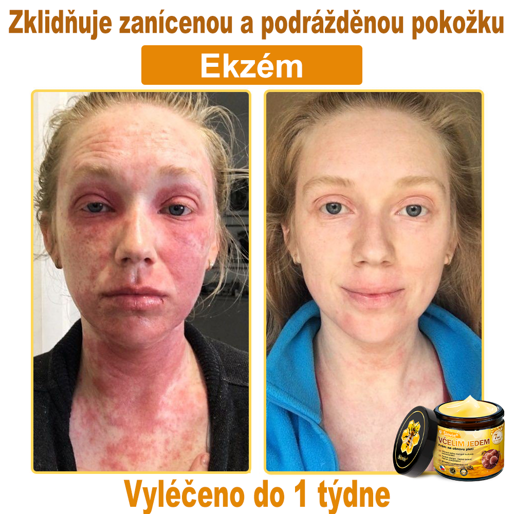 Sinvie® Krém na obnovu pleti s včelím jedem | 50 ml | Doporučeno Českou dermatovenerologickou společností